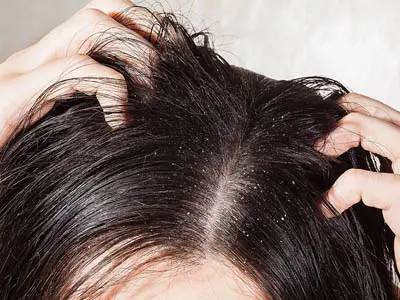 malasezzia infection Painful or Inflamed Acne