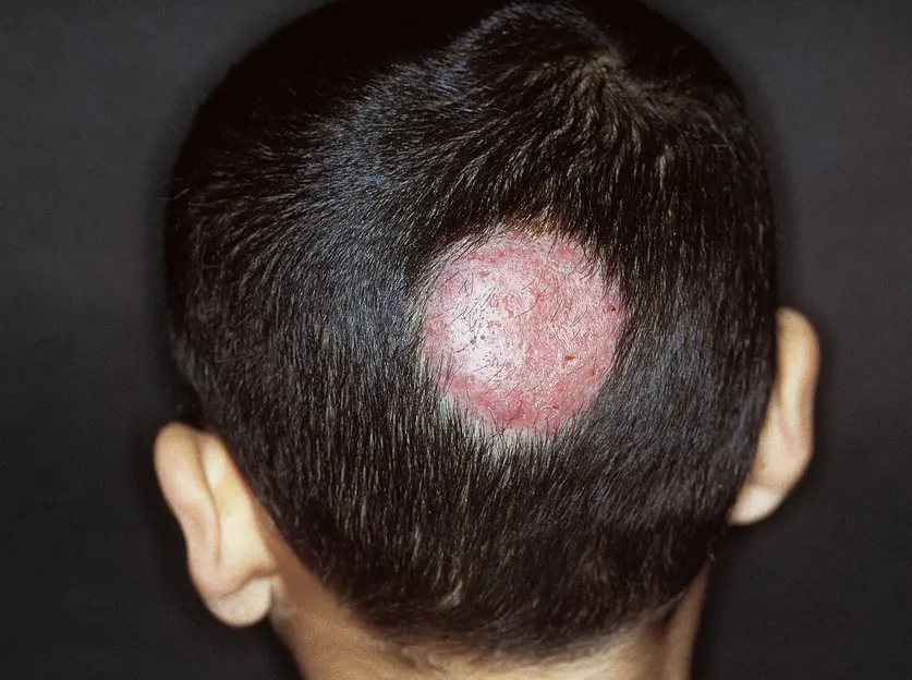 ringworm infection – tinea capitis Acne Causing Scarring